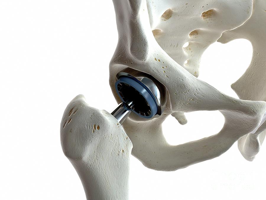 Illustration Of A Hip Replacement #11 Photograph by Sebastian Kaulitzki/science Photo Library