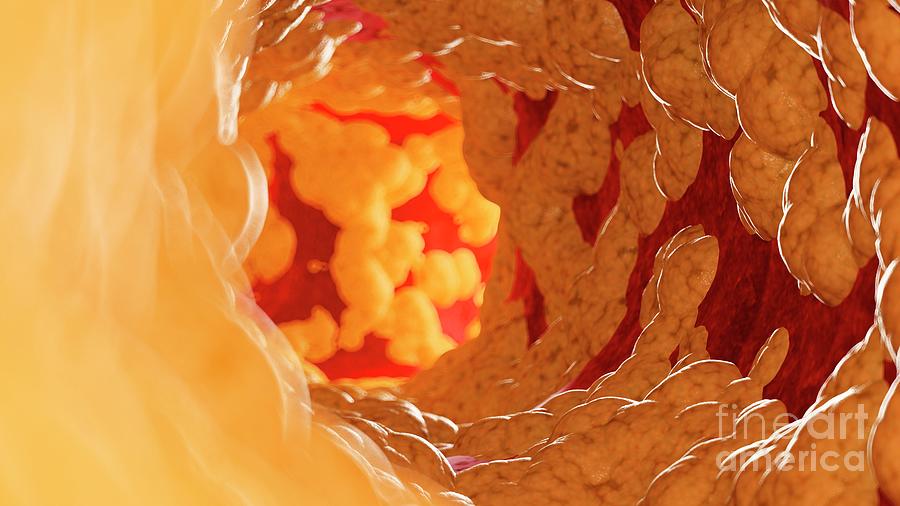 Illustration Of Fat Inside Of An Artery #11 Photograph by Sebastian Kaulitzki/science Photo Library