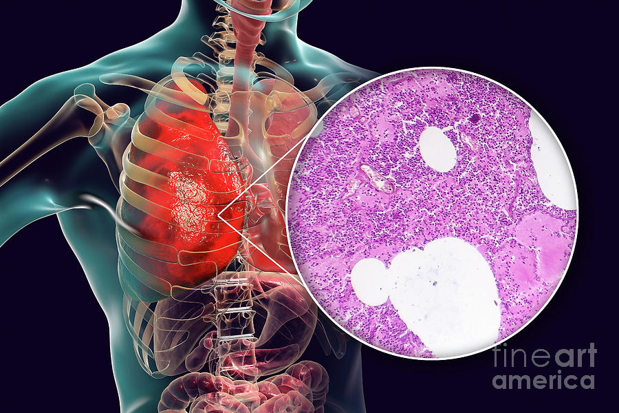 Lobar Pneumonia Photograph by Kateryna Kon/science Photo Library - Fine ...