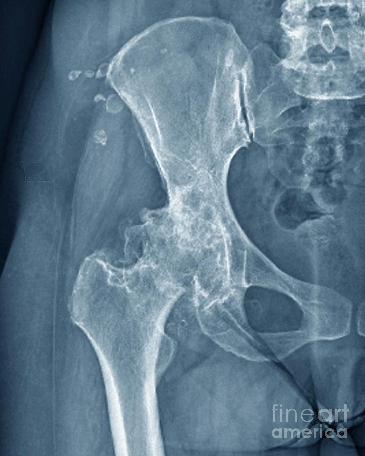 Osteoarthritis Photograph - Osteoarthritis Of The Hip #11 by Zephyr/science Photo Library