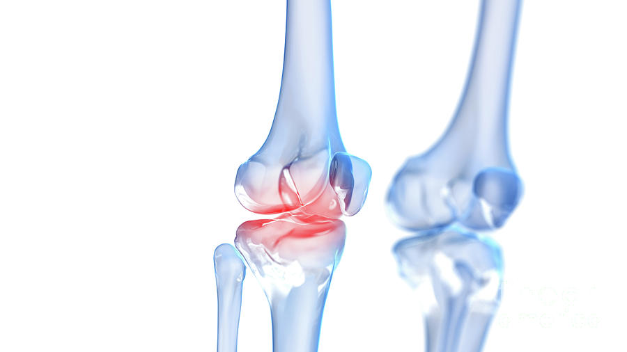 Painful Knee #11 Photograph by Sebastian Kaulitzki/science Photo Library