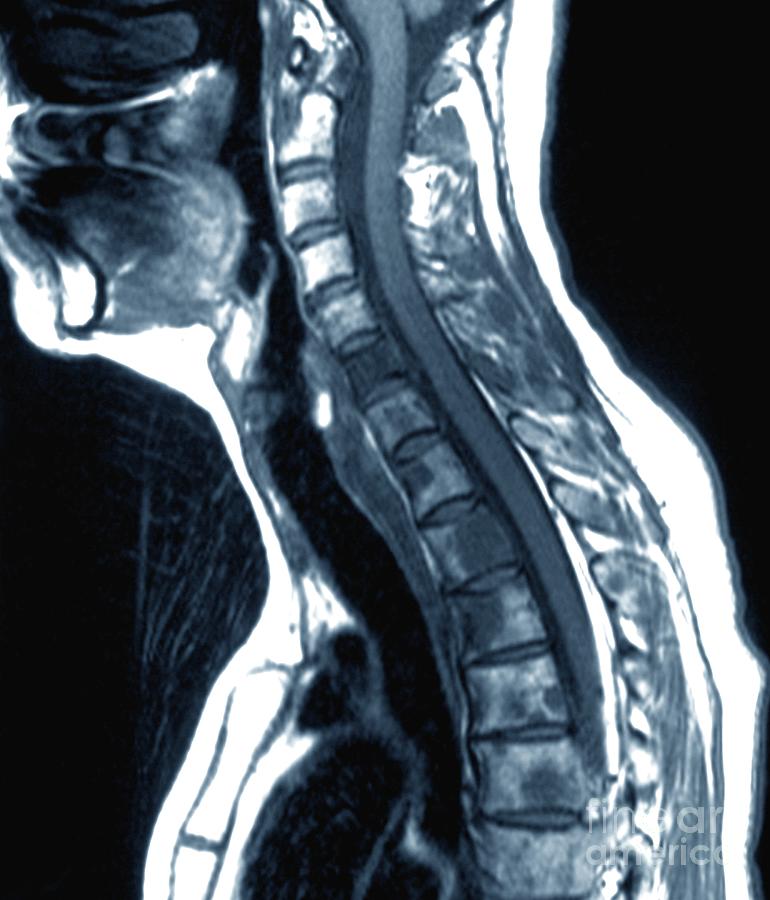 Secondary Bone Cancer In The Spine Photograph by Zephyr