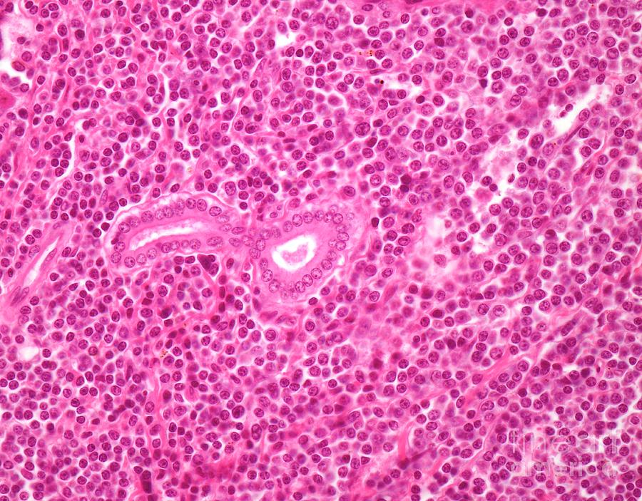 small lymphocytic lymphoma        
        <figure class=