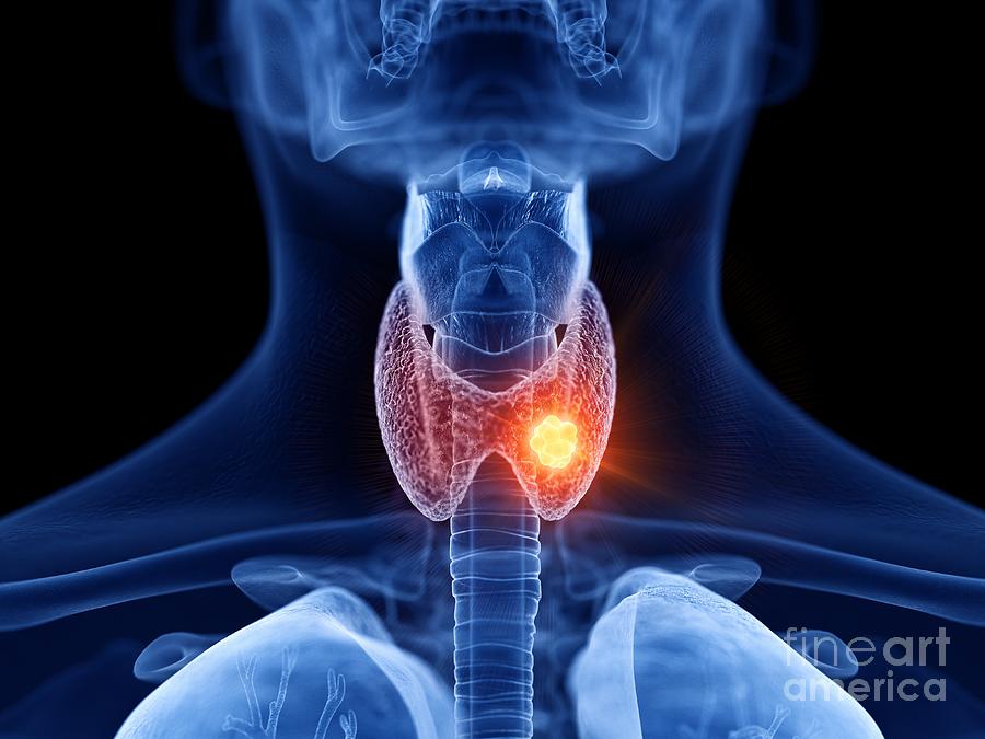 Thyroid Cancer Photograph by Sebastian Kaulitzki/science Photo Library ...