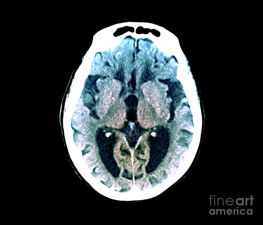 Alzheimers Disease #12 Photograph by Zephyr/science Photo Library