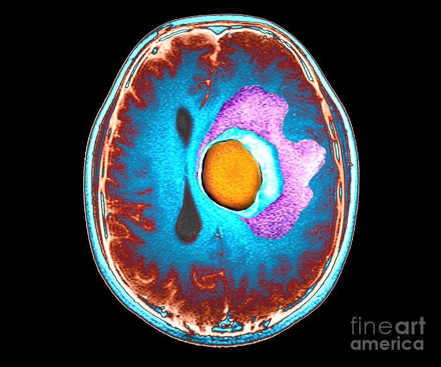 Male Photograph - Brain Cancer by Zephyr/science Photo Library Male Photograph - Brain Cancer by Zephyr/science Photo Library