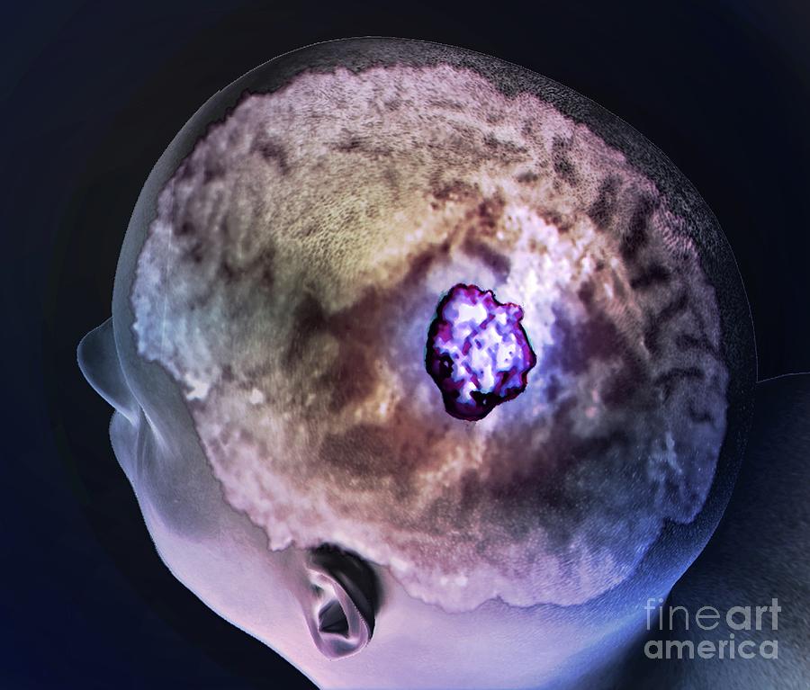 Brain Tumour #12 Photograph by Zephyr/science Photo Library