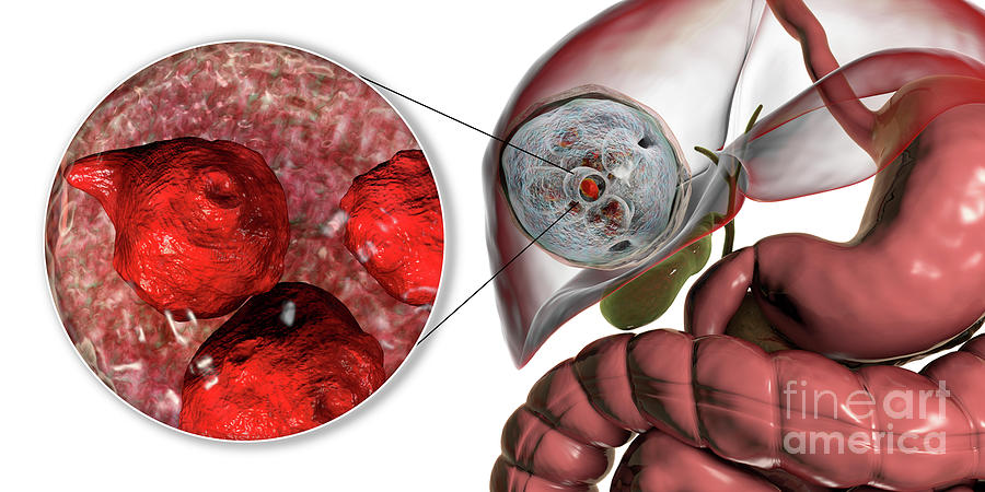 Hydatid Disease In Liver Photograph by Kateryna Kon/science Photo ...