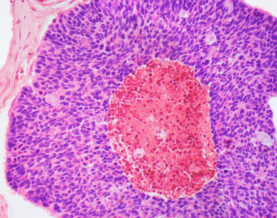 Lung Cancer #12 Photograph by Steve Gschmeissner/science Photo Library
