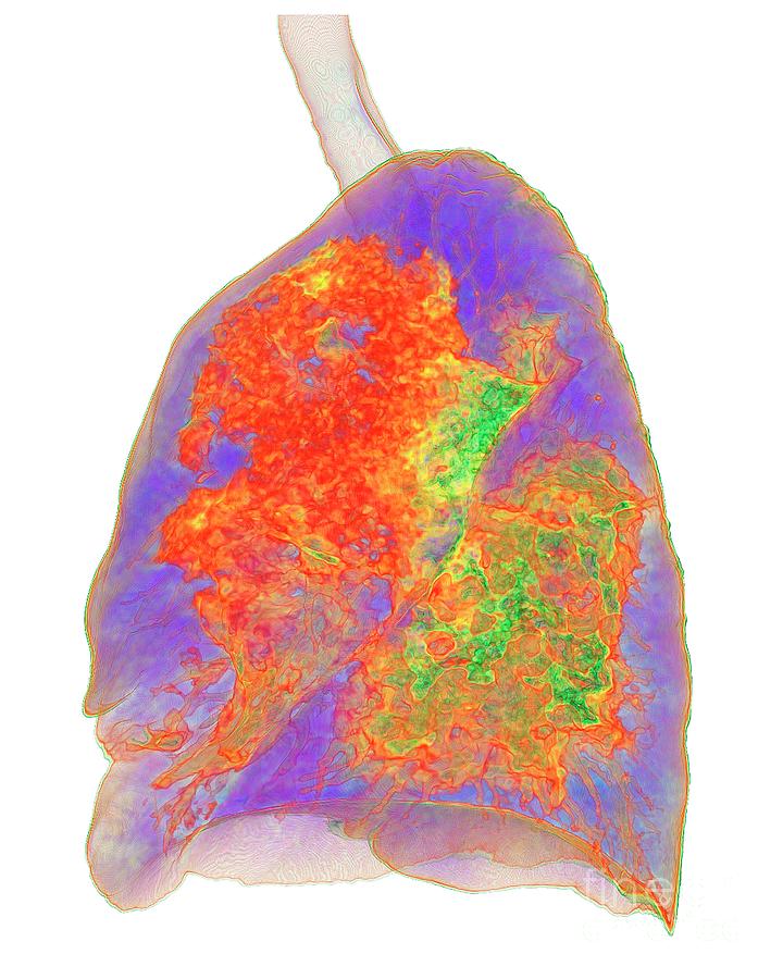 Lungs Affected By Covid-19 Atypical Pneumonia Photograph by K H Fung ...