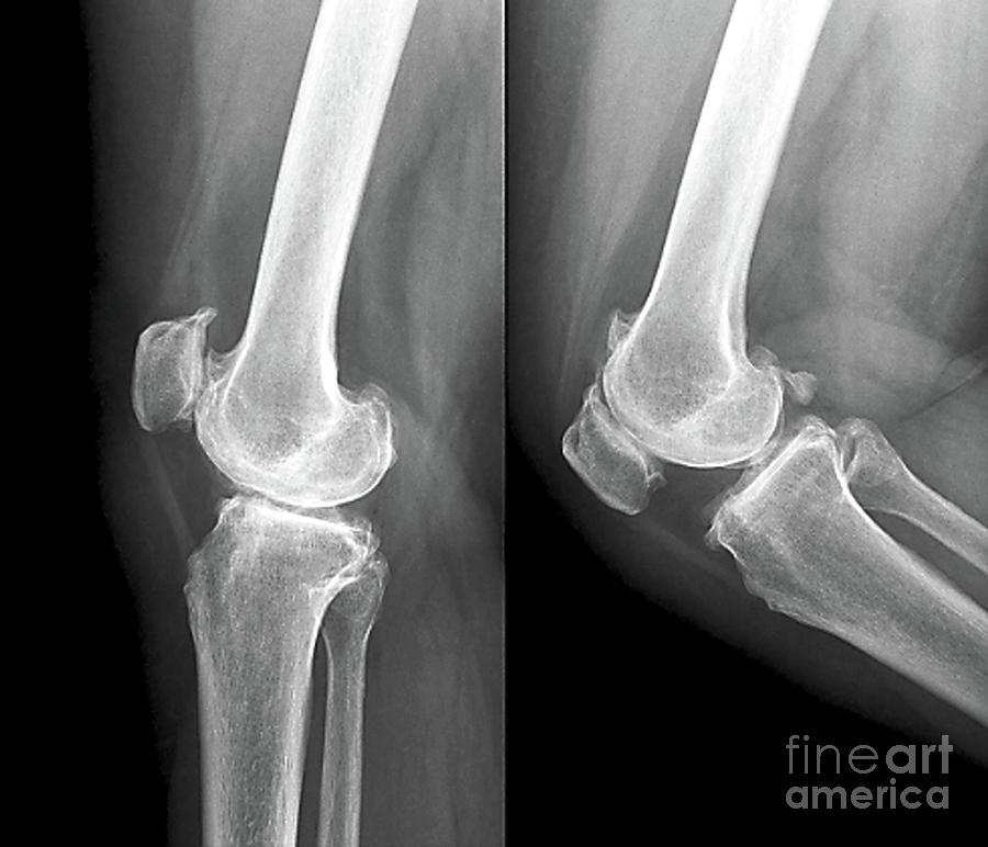 Osteoarthritis Of The Knee Photograph By Zephyrscience Photo Library