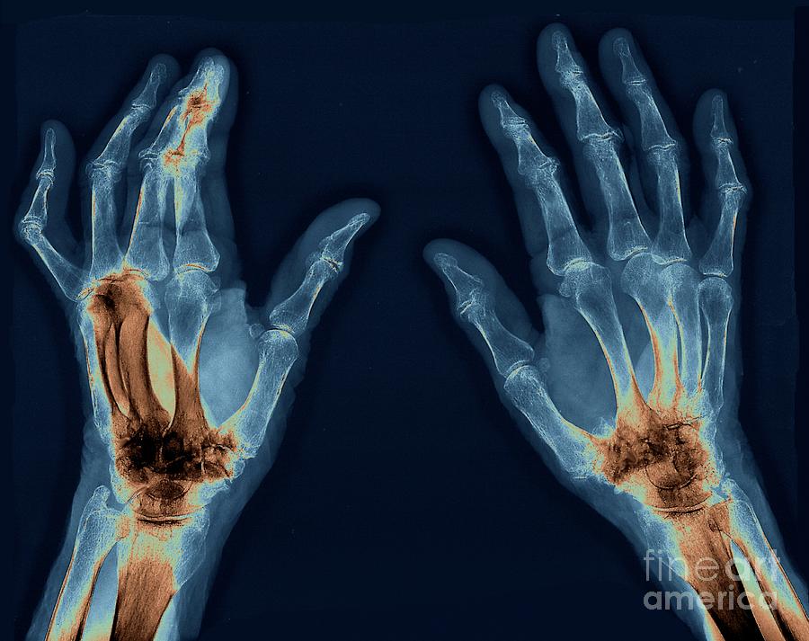 Osteoarthritis Photograph By Zephyr/science Photo Library - Pixels