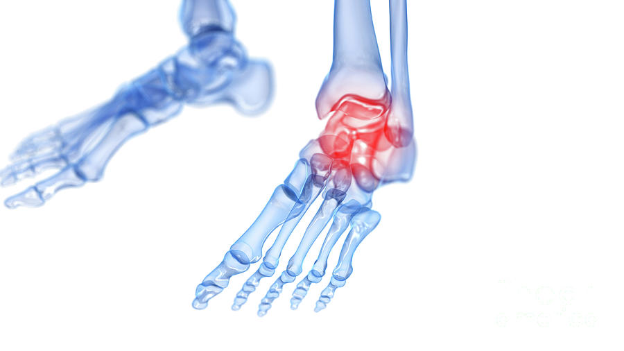 Painful Ankle #12 Photograph by Sebastian Kaulitzki/science Photo Library