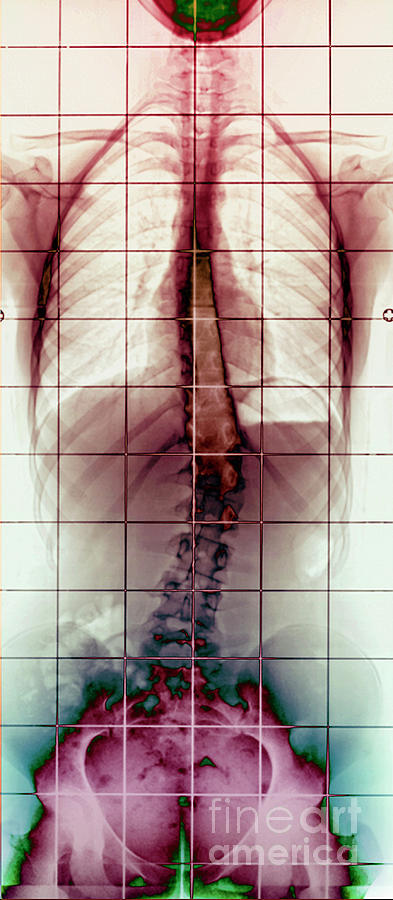 Scoliosis #12 Photograph by Zephyr/science Photo Library
