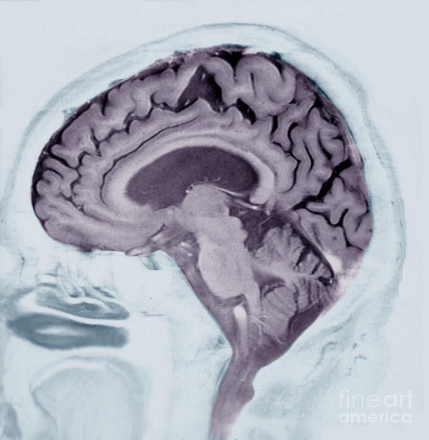 Alzheimers Disease #13 Photograph by Zephyr/science Photo Library