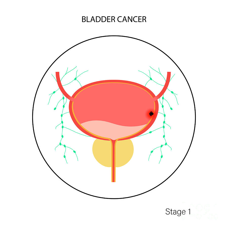 Bladder Photograph - Bladder Cancer Stages #13 by Pikovit / Science Photo Library