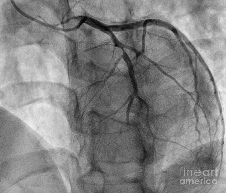 Coronary Artery Stenosis #13 Photograph By Zephyr/science Photo Library ...