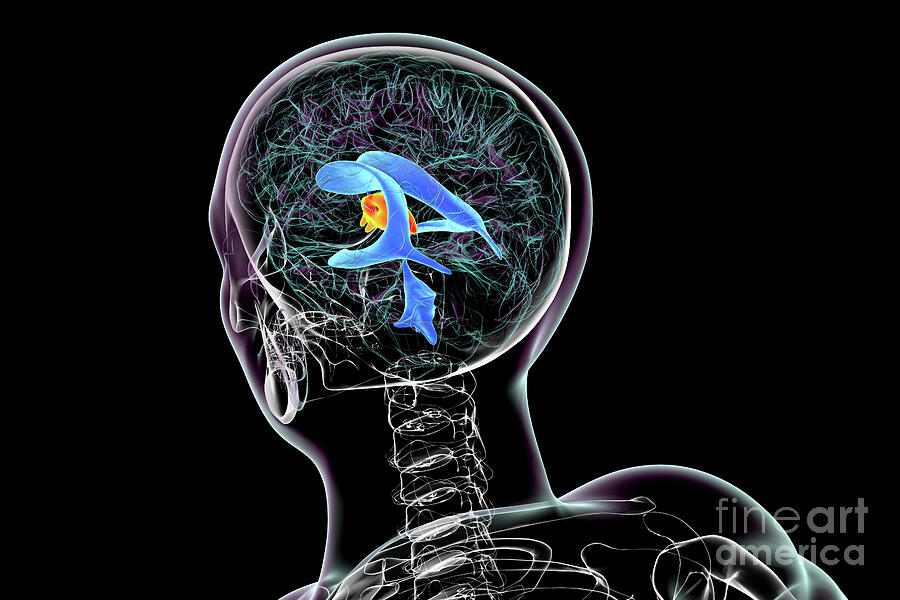 Enlargement Of The Third Brain Ventricle #13 Photograph by Kateryna Kon/science Photo Library Enlargement Of The Third Brain Ventricle #13 Photograph by Kateryna Kon/science Photo Library