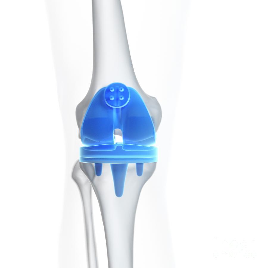 Illustration Of A Knee Replacement #13 Photograph by Sebastian Kaulitzki/science Photo Library