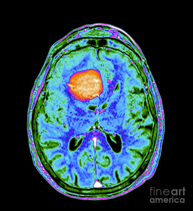 Meningioma Brain Tumour #13 by Science Photo Library