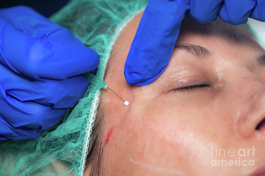 Mesotherapy Thread Face Lift Procedure #13 Photograph by Microgen Images/science Photo Library