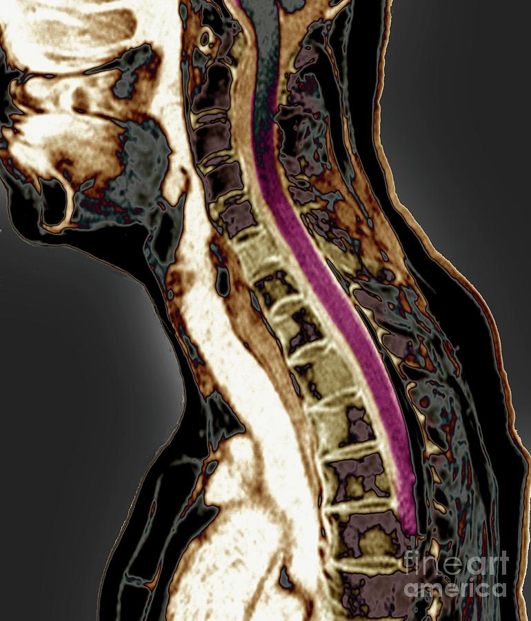 Secondary Bone Cancer In The Spine #13 Photograph by Zephyr/science Photo Library