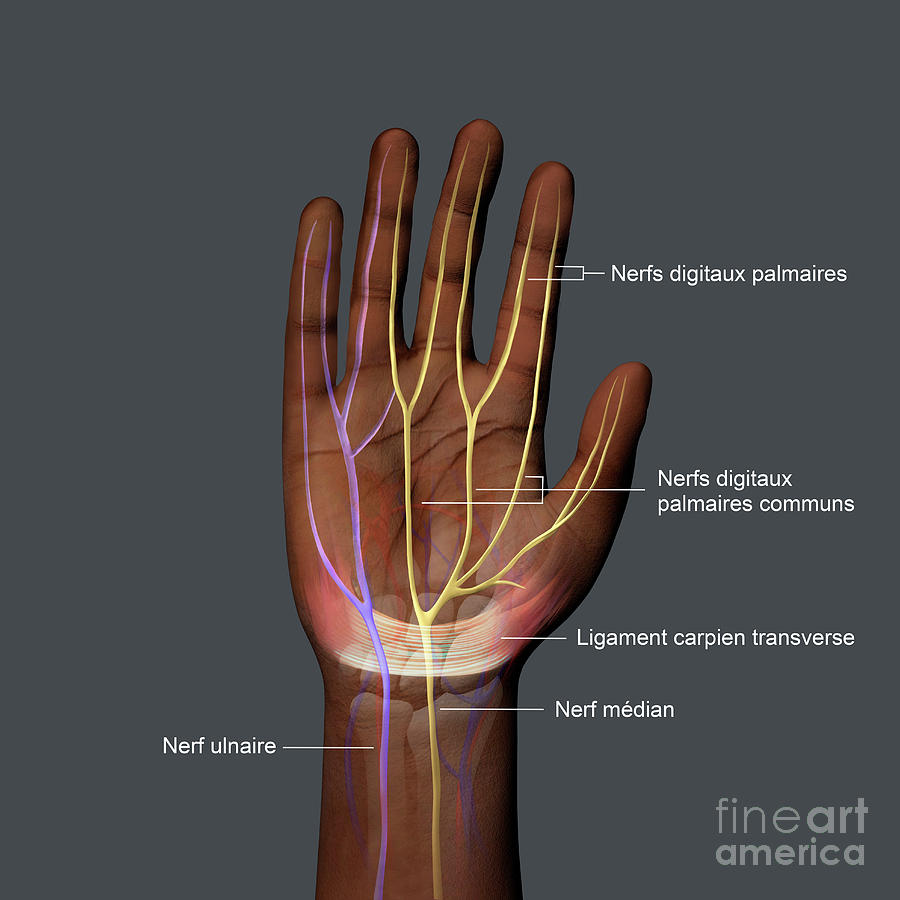 Carpal Tunnel Syndrome Photograph by Fernando Da Cunha/science Photo ...