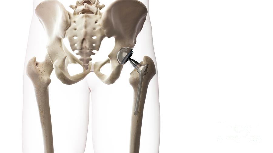 Hip Replacement Photograph By Sebastian Kaulitzki Science Photo Library