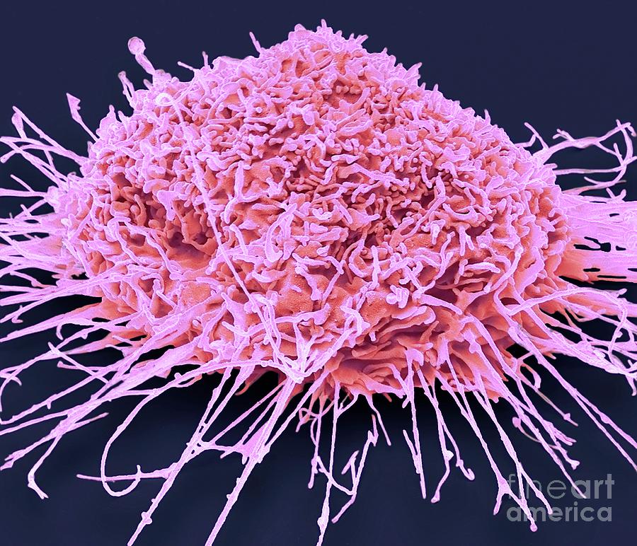 Lung Cancer Cell Photograph by Steve Gschmeissner/science Photo Library ...