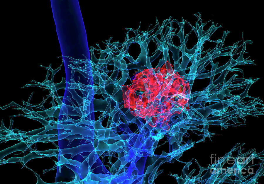 Lung Cancer Photograph - Lung Cancer #14 by K H Fung/science Photo Library