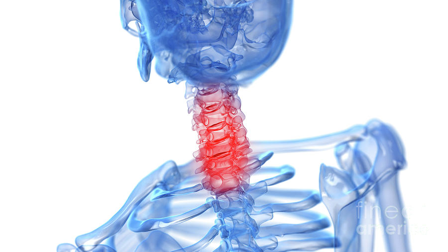 Painful Neck #14 Photograph by Sebastian Kaulitzki/science Photo Library