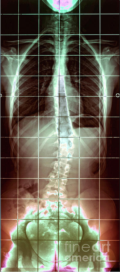 Medical Photograph - Scoliosis #14 by Zephyr/science Photo Library
