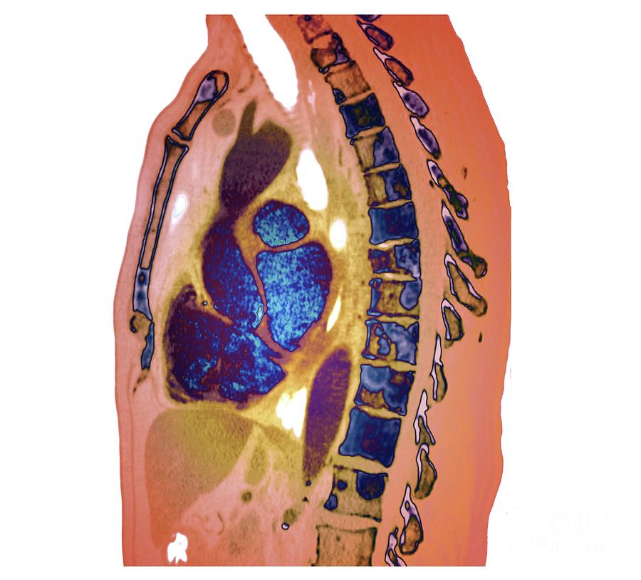 secondary-bone-cancer-in-the-spine-photograph-by-zephyr-science-photo