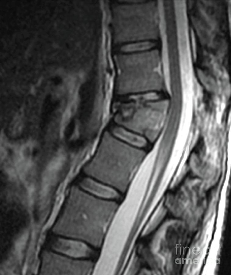 Thoracic Spine Fracture Photograph By Zephyr/science Photo Library ...