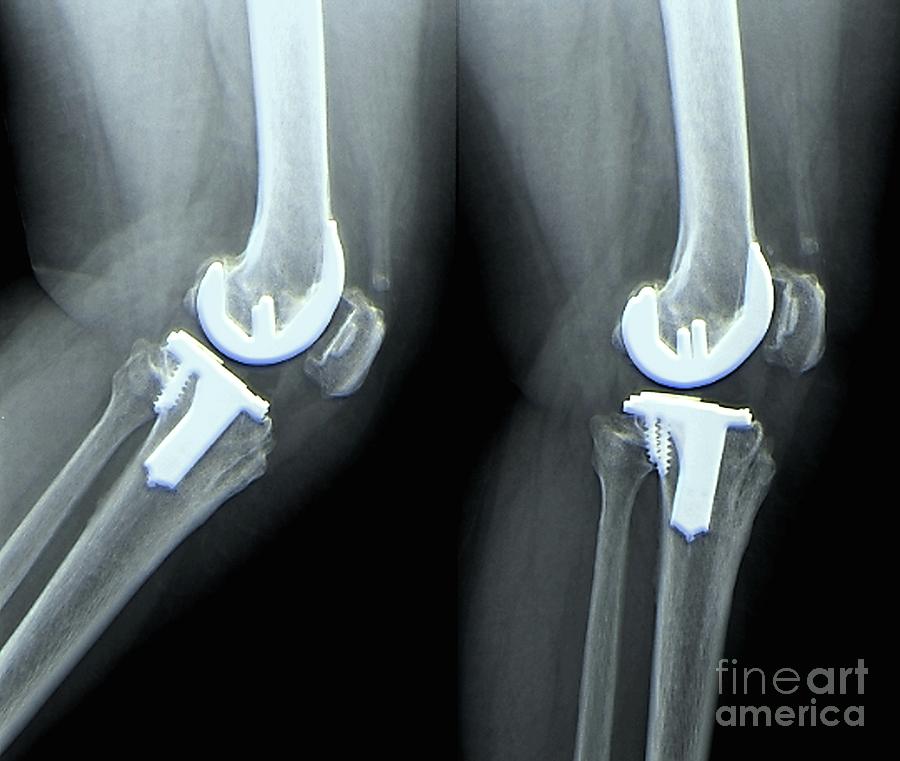 Total Knee Replacement 14 By Zephyrscience Photo Library