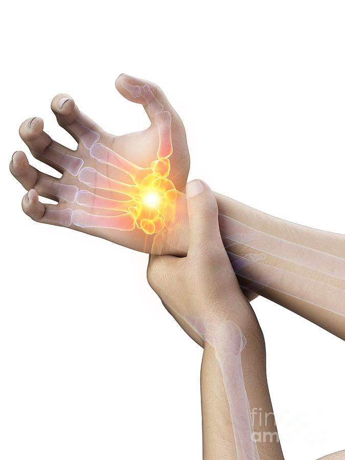 3d Photograph - Wrist Pain #14 by Sebastian Kaulitzki/science Photo Library