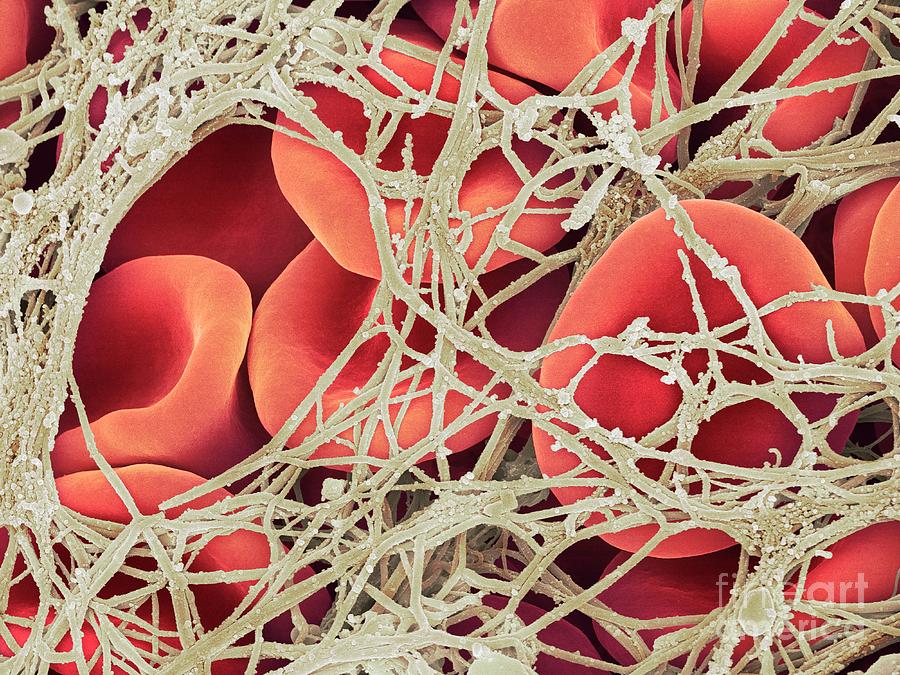 Blood Clot Photograph by Dennis Kunkel Microscopy/science Photo Library ...