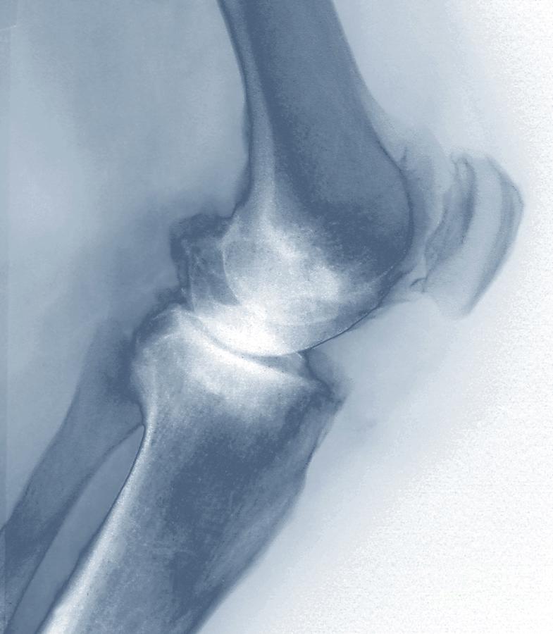 Osteoarthritis Of The Knee #15 Photograph by Zephyr/science Photo Library
