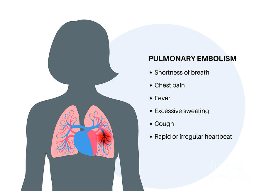 Pulmonary embolism photograph by pikovit science photo library fine