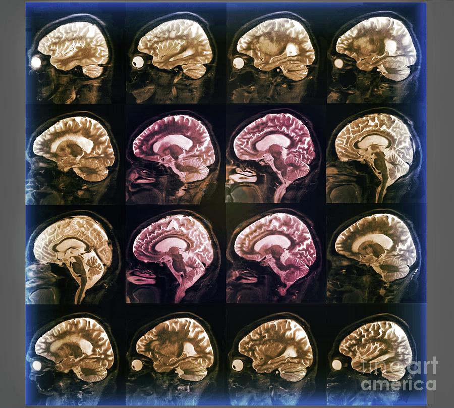 Alzheimers Disease #16 Photograph by Zephyr/science Photo Library
