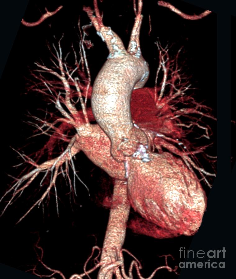 Aortic Aneurysm 16 By Zephyrscience Photo Library 9647