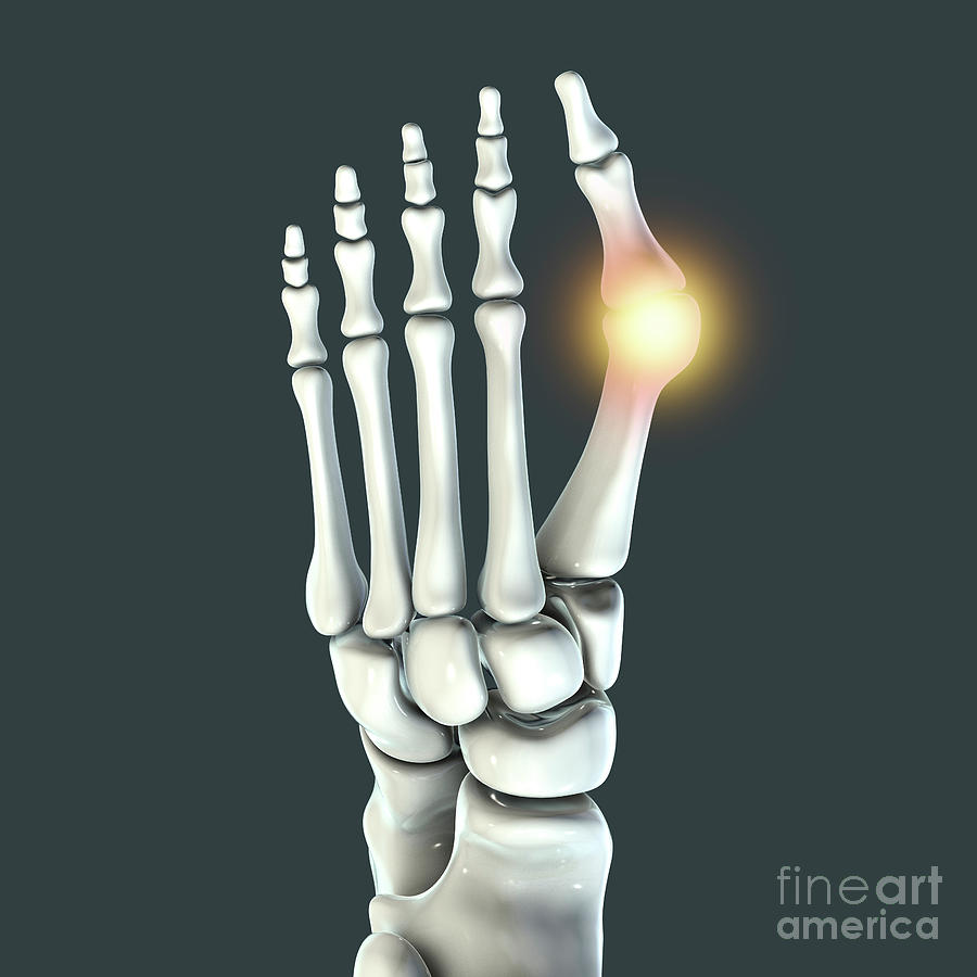 Bunion #16 Photograph by Kateryna Kon/science Photo Library