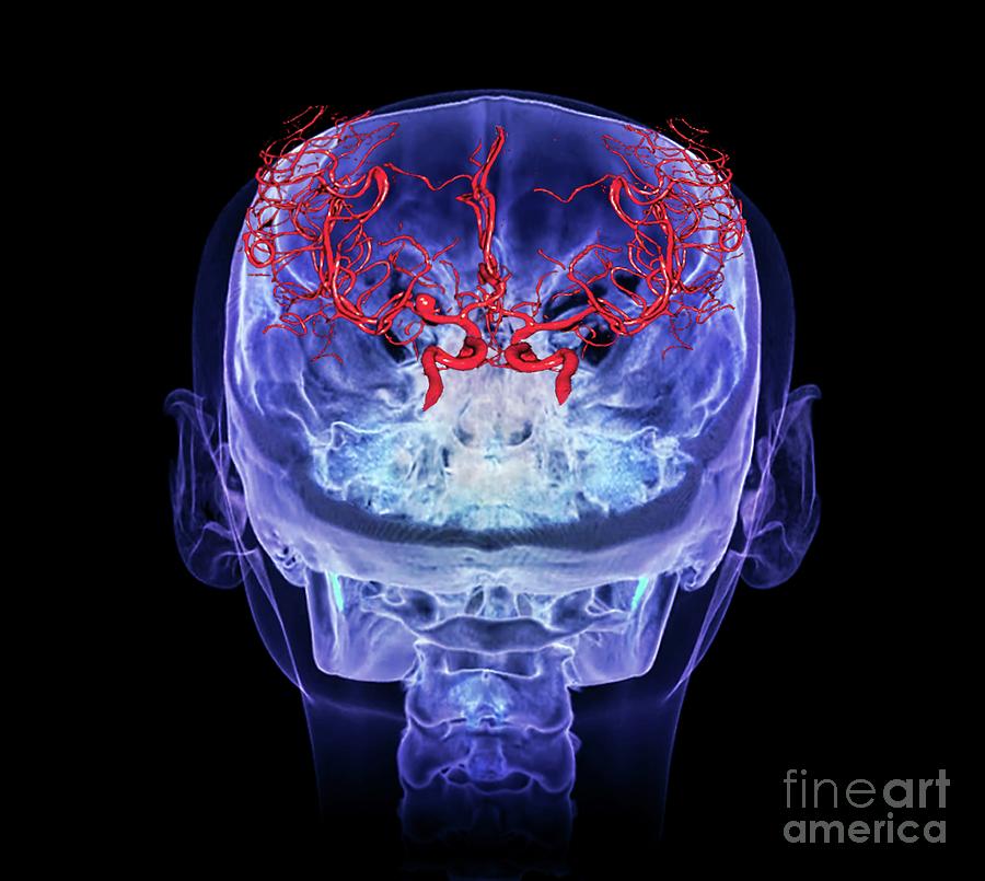 Cerebral Aneurysm #16 by Zephyr/science Photo Library