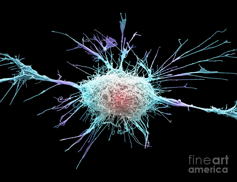 Cervical Cancer Cell Photograph by Anne E. Weston/science Photo Library ...