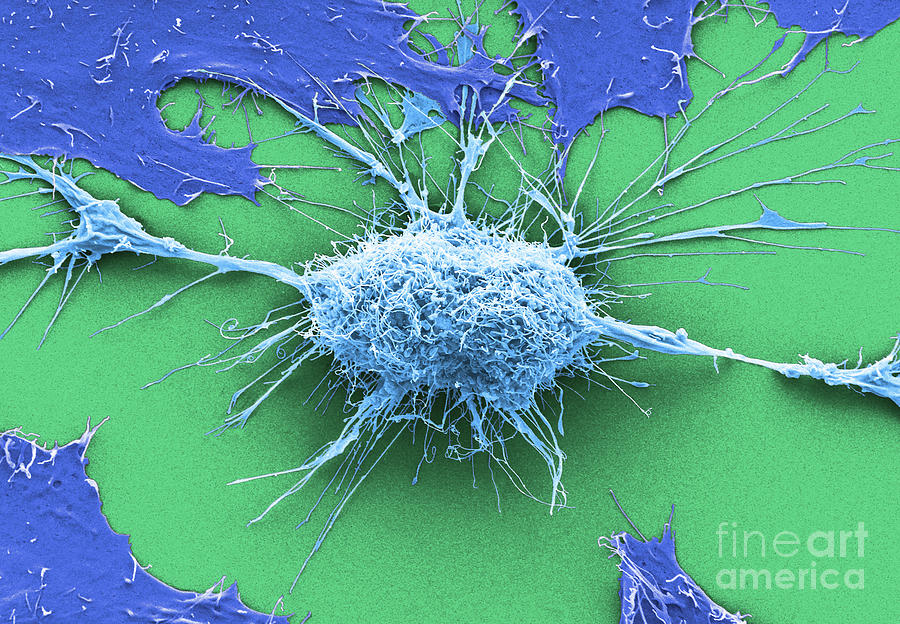 cervical cancer cells