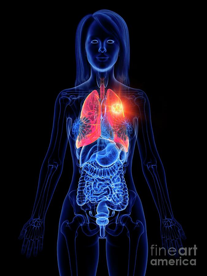 Lung Cancer #16 Photograph by Sebastian Kaulitzki/science Photo Library