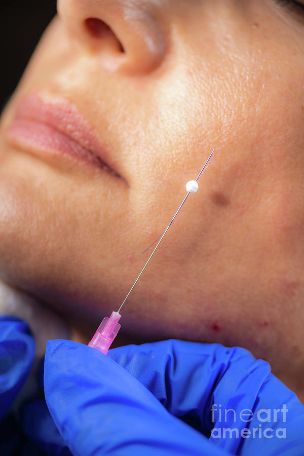 Mesotherapy Thread Face Lift Procedure #16 Photograph by Microgen Images/science Photo Library