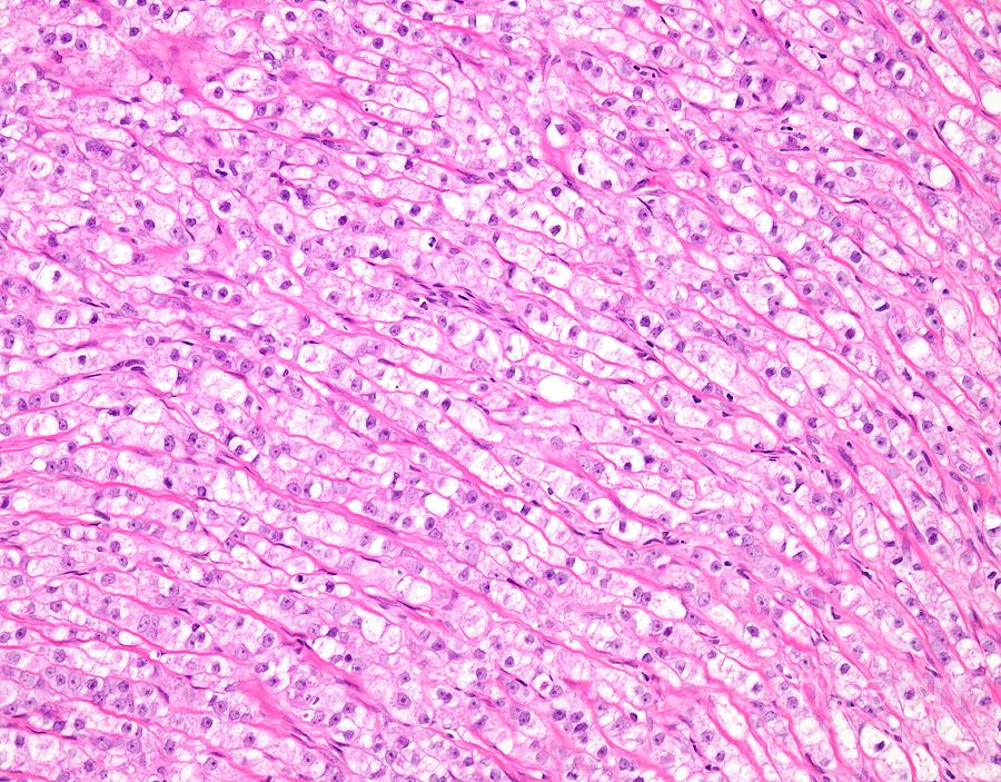 Prostate Cancer Photograph by Webpathology/science Photo Library