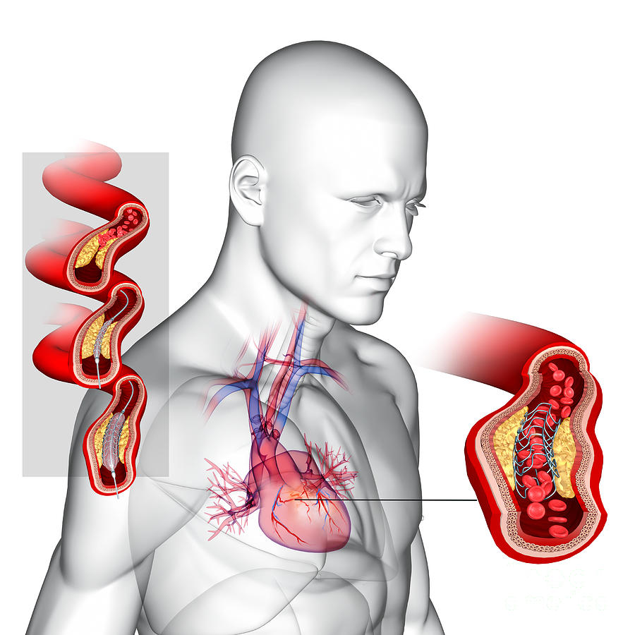 Angioplasty With Stent Placement Photograph by Fernando Da Cunha ...