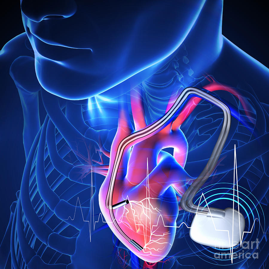 Pacemaker Photograph by Fernando Da Cunha/science Photo Library | Pixels